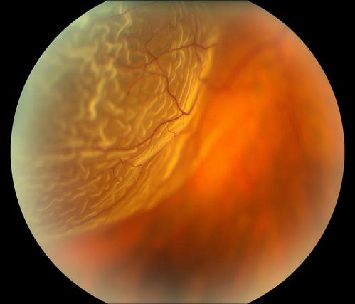 Retinal Detachment
Keywords: Retinal Detachment
