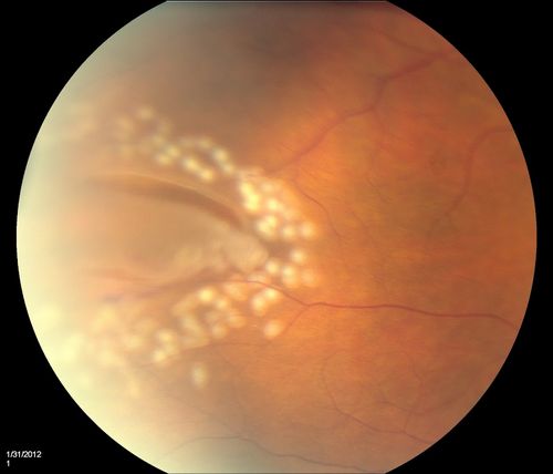 Retinal Tear with Laser
Keywords: Retinal Detachment
