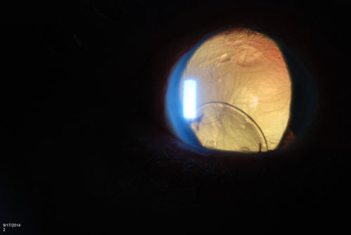 Free Floating Dislocated Lens in Vitreous
Patient comes in aphakic with dislocated lens floating to the back of the eye when laying down. Lens is  laying up against the endothelium of the cornea when patient is right side up..
