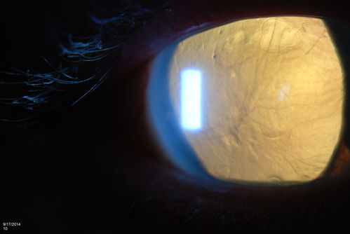Free Floating Dislocated Lens in Vitreous
Patient comes in aphakic with dislocated lens floating to the back of the eye when laying down. Lens is  laying up against the endothelium of the cornea when patient is right side up..
