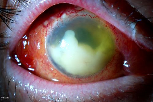 Endophthalmitis with Hypopion
