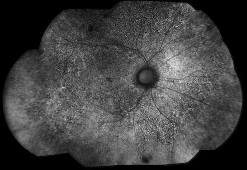 Choroidal Dystrophy
Schlüsselwörter: dystrophy