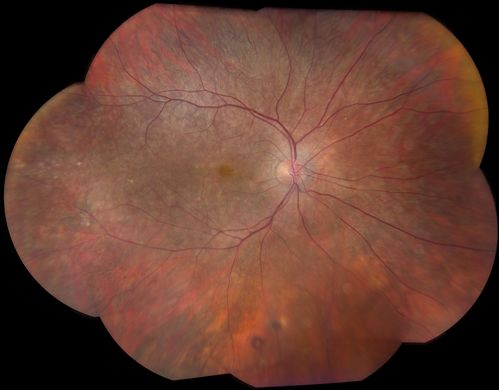 Choroidal Dystrophy
Keywords: dystrophy
