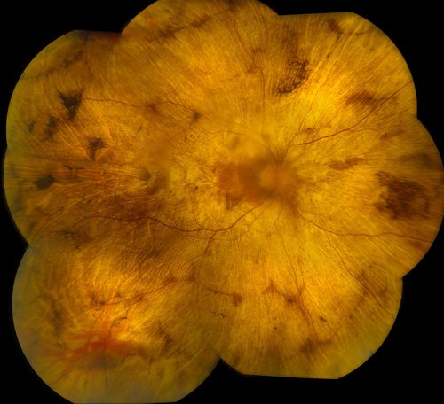 Choroideremia
62-year old female who has extensive retinal damage in both eyes. VA 20/50 right eye, HM, left eye. Spot in vision, which is PSC, both eyes. 
Keywords: august2012