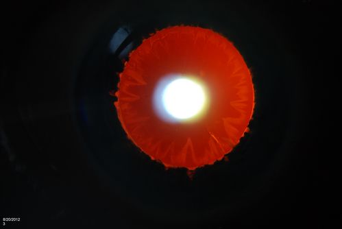 Pseudoexfoliation Ring
Patient's VA 20/50 with pinhole no improvement. Patient will have cataract surgery in the future. Notice Pseudoexfoliation ring centrally.
