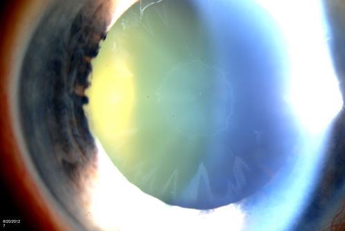 Pseudoexfoliation Ring
Patient's VA 20/50 with pinhole no improvement. Patient will have cataract surgery in the future. Notice Pseudoexfoliation ring centrally.
