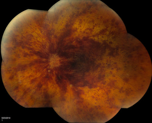 Retinal Vein Occlusion
Patient comes in with loss of vision, left eye. VA is count fingers in the left eye. Fundus photos show large vein occlusion with macular edema in the left eye. Patient proceeded with Avastin Injection..
