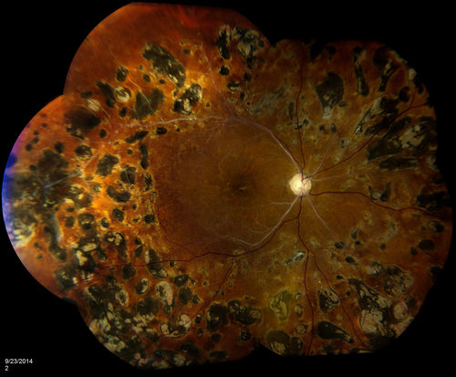 Retinal Artery Occlusion
Patient comes in for eval on artery occlusions in both eyes. VA is 20/400, right eye and NLP, left eye. Fundus photos show paniretinal scars in the right eye with arterial narrowing and the left eye has arterial narrowing as well.
