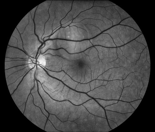 Retinal Pigment Epithelial Detachment with no Sub-Retinal Fluid...
A 38-year old male who comes in with blurred vision in the left eye. VA is 20/30. Notices a defect inferior of his central vision. Did an Fluorescence Angiogram to determine an RPE with no sub retinal fluid. Also OCT confirms. Patient was injected with Avastin.
