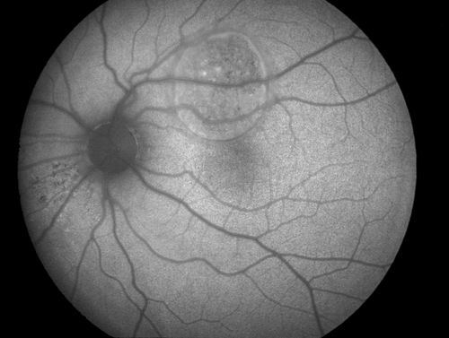 Retinal Pigment Epithelial Detachment with no Sub-Retinal Fluid...
A 38-year old male who comes in with blurred vision in the left eye. VA is 20/30. Notices a defect inferior of his central vision. Did an Fluorescence Angiogram to determine an RPE with no sub retinal fluid. Also OCT confirms. Patient was injected with Avastin.
