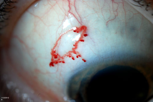 Conjunctival Vascular Anomaly
Patient presents a vascular pattern of blood vessels @ 10 o'clock of the superior-temporal quadrant of the right eye. Patient has had flare ups with anterior scleritis in the past  which is controlled by Methotrexate. Patient's VA is currently 20/40 with PH 20/30, right eye.  
