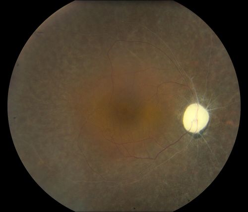 Retinal Pigmintosa
28-year old female with no light perception in the right eye. 
Schlüsselwörter: november2012