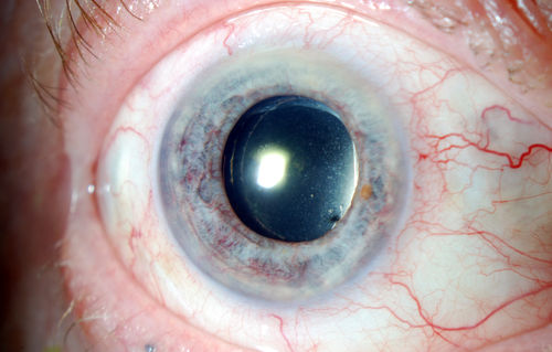 Rubeosis Iridis
Patient presents with Rubeosis Iridis in the right eye due to neovascular glaucoma. VA is 20/40 in the right eye. Will follow up in 3-months.
