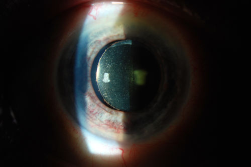 Rubeosis Iridis
Patient presents with Rubeosis Iridis in the right eye due to neovascular glaucoma. VA is 20/40 in the right eye. Will follow up in 3-months.
