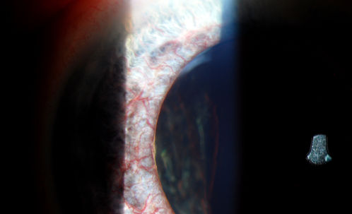 Rubeosis Iridis
Patient presents with Rubeosis Iridis in the right eye due to neovascular glaucoma. VA is 20/40 in the right eye. Will follow up in 3-months.
