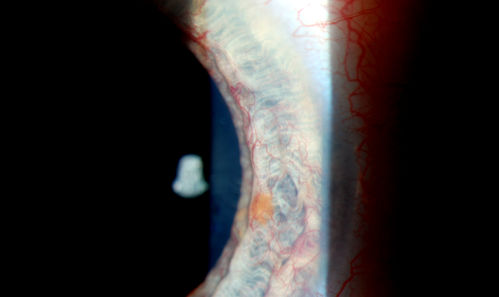 Rubeosis Iridis
Patient presents with Rubeosis Iridis in the right eye due to neovascular glaucoma. VA is 20/40 in the right eye. Will follow up in 3-months.
