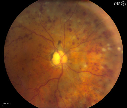 Central Retinal Vein Occlusion with Macular Edema and Retinal Hemorrhages 
Female patient of 86-years of age presents a central retinal vein occlusion with macular edema in the right eye. Patient's VA was 20/70 in the right eye. Proceeded with laser treatment to the right eye.
