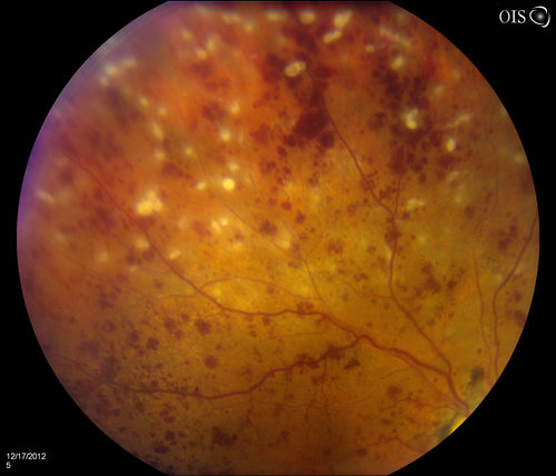 Central Retinal Vein Occlusion with Macular Edema and Retinal Hemorrhages 
Female patient of 86-years of age presents a central retinal vein occlusion with macular edema in the right eye. Patient's VA was 20/70 in the right eye. Proceeded with laser treatment to the right eye.
