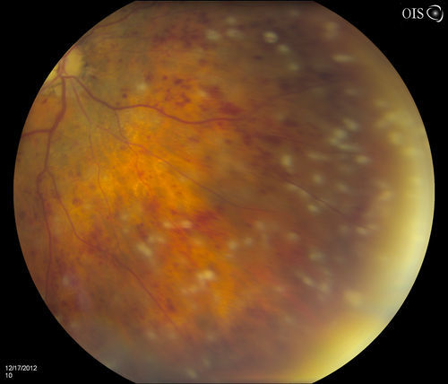 Central Retinal Vein Occlusion with Macular Edema and Retinal Hemorrhages 
Female patient of 86-years of age presents a central retinal vein occlusion with macular edema in the right eye. Patient's VA was 20/70 in the right eye. Proceeded with laser treatment to the right eye.

