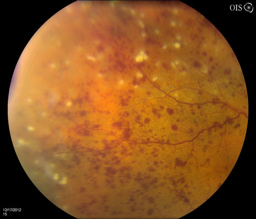 Central Retinal Vein Occlusion with Macular Edema and Retinal Hemorrhages 
Female patient of 86-years of age presents a central retinal vein occlusion with macular edema in the right eye. Patient's VA was 20/70 in the right eye. Proceeded with laser treatment to the right eye.

