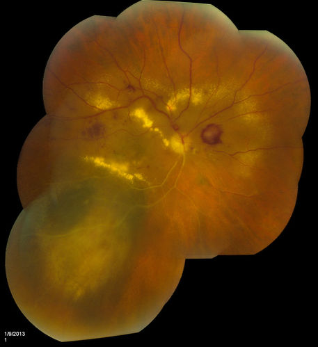 Choroidal Melanoma with Radiation Retinopathy
Patient comes with follow up on Choroidal Melanoma, Right Eye that was treated back in June of 2009 with Radioactive Implant. Vein Occlusion is also present with VA - Hand Motion. Hemorrhages visible with hard exudates from the Radiation Retinopathy.  
Keywords: february2013