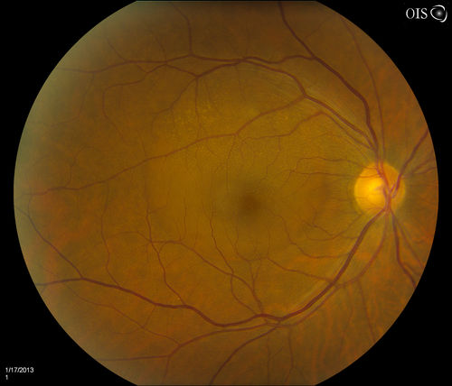 Central Serous Retinopathy
Patient comes in with blurred vision. Patient also had a lung transplant. VA was 20/150 with pinhole correction to 20/60 in the right eye. Fundus exam in the right eye shows a great amount of sub retinal fluid over the macula. Will monitor to see if it goes away on its own, if not then will consider laser treatment. 
