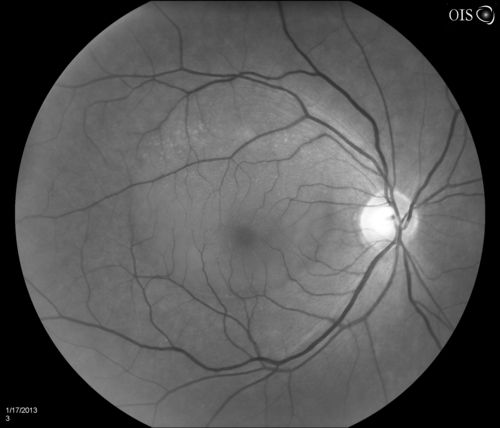 Central Serous Retinopathy
Patient comes in with blurred vision. Patient also had a lung transplant. VA was 20/150 with pinhole correction to 20/60 in the right eye. Fundus exam in the right eye shows a great amount of sub retinal fluid over the macula. Will monitor to see if it goes away on its own, if not then will consider laser treatment. 

