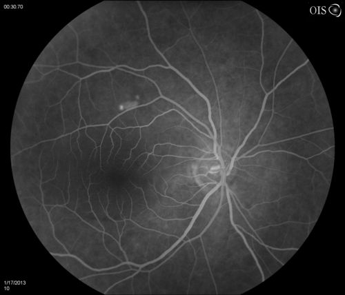 Central Serous Retinopathy
Patient comes in with blurred vision. Patient also had a lung transplant. VA was 20/150 with pinhole correction to 20/60 in the right eye. Fundus exam in the right eye shows a great amount of sub retinal fluid over the macula. Will monitor to see if it goes away on its own, if not then will consider laser treatment. 
