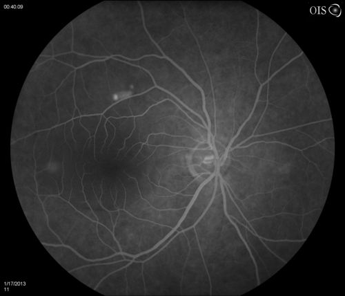 Central Serous Retinopathy
Patient comes in with blurred vision. Patient also had a lung transplant. VA was 20/150 with pinhole correction to 20/60 in the right eye. Fundus exam in the right eye shows a great amount of sub retinal fluid over the macula. Will monitor to see if it goes away on its own, if not then will consider laser treatment. 
