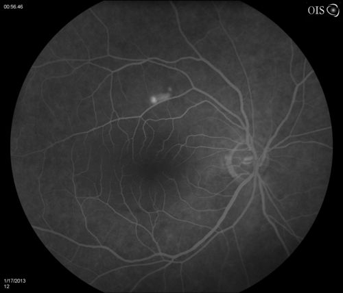 Central Serous Retinopathy
Patient comes in with blurred vision. Patient also had a lung transplant. VA was 20/150 with pinhole correction to 20/60 in the right eye. Fundus exam in the right eye shows a great amount of sub retinal fluid over the macula. Will monitor to see if it goes away on its own, if not then will consider laser treatment. 
