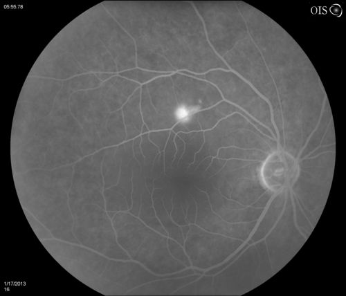 Central Serous Retinopathy
Patient comes in with blurred vision. Patient also had a lung transplant. VA was 20/150 with pinhole correction to 20/60 in the right eye. Fundus exam in the right eye shows a great amount of sub retinal fluid over the macula. Will monitor to see if it goes away on its own, if not then will consider laser treatment. 
