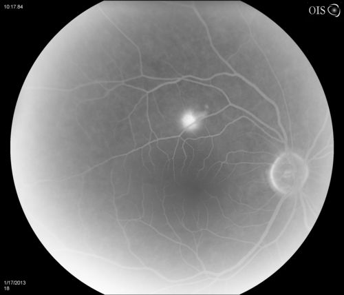 Central Serous Retinopathy
Patient comes in with blurred vision. Patient also had a lung transplant. VA was 20/150 with pinhole correction to 20/60 in the right eye. Fundus exam in the right eye shows a great amount of sub retinal fluid over the macula. Will monitor to see if it goes away on its own, if not then will consider laser treatment. 
