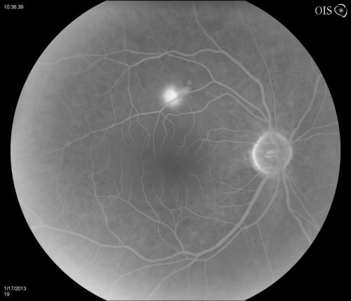 Central Serous Retinopathy
Patient comes in with blurred vision. Patient also had a lung transplant. VA was 20/150 with pinhole correction to 20/60 in the right eye. Fundus exam in the right eye shows a great amount of sub retinal fluid over the macula. Will monitor to see if it goes away on its own, if not then will consider laser treatment. 

