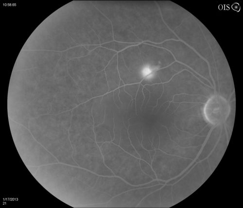 Central Serous Retinopathy
Patient comes in with blurred vision. Patient also had a lung transplant. VA was 20/150 with pinhole correction to 20/60 in the right eye. Fundus exam in the right eye shows a great amount of sub retinal fluid over the macula. Will monitor to see if it goes away on its own, if not then will consider laser treatment. 
