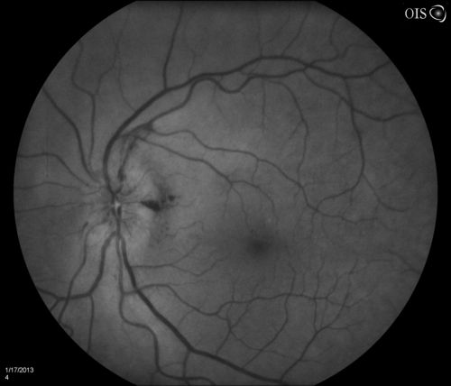 Diabetic Papillitis
Patient is about to undergo surgery for CNS Aneurysm. Patient woke up with little spots which never cleared up. Patients VA was 20/30-OD and 20/40-OS.  Both eyes appeared to have disc edema with hemorrhages in the right eye. Ordered a CT of the brain to make sure the aneurysm didn't ruptured.
