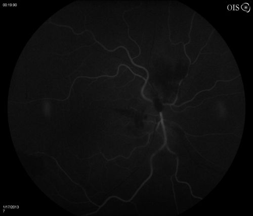 Diabetic Papillitis
Patient is about to undergo surgery for CNS Aneurysm. Patient woke up with little spots which never cleared up. Patients VA was 20/30-OD and 20/40-OS.  Both eyes appeared to have disc edema with hemorrhages in the right eye. Ordered a CT of the brain to make sure the aneurysm didn't ruptured.
