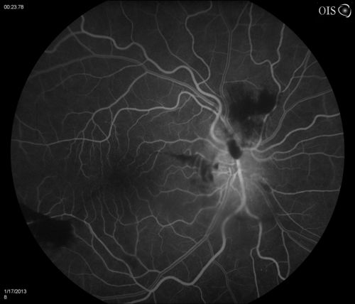Diabetic Papillitis
Patient is about to undergo surgery for CNS Aneurysm. Patient woke up with little spots which never cleared up. Patients VA was 20/30-OD and 20/40-OS.  Both eyes appeared to have disc edema with hemorrhages in the right eye. Ordered a CT of the brain to make sure the aneurysm didn't ruptured.
