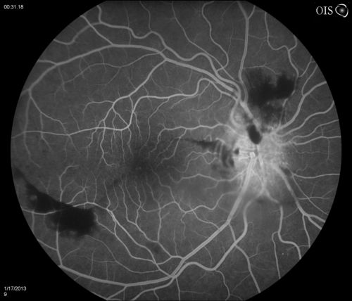 Diabetic Papillitis
Patient is about to undergo surgery for CNS Aneurysm. Patient woke up with little spots which never cleared up. Patients VA was 20/30-OD and 20/40-OS.  Both eyes appeared to have disc edema with hemorrhages in the right eye. Ordered a CT of the brain to make sure the aneurysm didn't ruptured.

