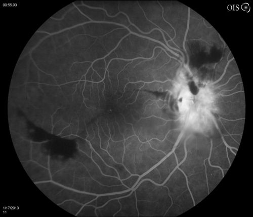 Diabetic Papillitis
Patient is about to undergo surgery for CNS Aneurysm. Patient woke up with little spots which never cleared up. Patients VA was 20/30-OD and 20/40-OS.  Both eyes appeared to have disc edema with hemorrhages in the right eye. Ordered a CT of the brain to make sure the aneurysm didn't ruptured.
