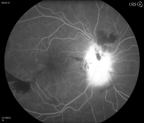 Diabetic Papillitis
Patient is about to undergo surgery for CNS Aneurysm. Patient woke up with little spots which never cleared up. Patients VA was 20/30-OD and 20/40-OS.  Both eyes appeared to have disc edema with hemorrhages in the right eye. Ordered a CT of the brain to make sure the aneurysm didn't ruptured.
