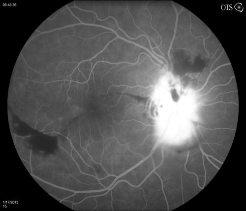 Diabetic Papillitis
Patient is about to undergo surgery for CNS Aneurysm. Patient woke up with little spots which never cleared up. Patients VA was 20/30-OD and 20/40-OS.  Both eyes appeared to have disc edema with hemorrhages in the right eye. Ordered a CT of the brain to make sure the aneurysm didn't ruptured.
