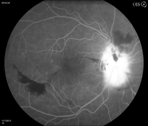 Diabetic Papillitis
Patient is about to undergo surgery for CNS Aneurysm. Patient woke up with little spots which never cleared up. Patients VA was 20/30-OD and 20/40-OS.  Both eyes appeared to have disc edema with hemorrhages in the right eye. Ordered a CT of the brain to make sure the aneurysm didn't ruptured.
