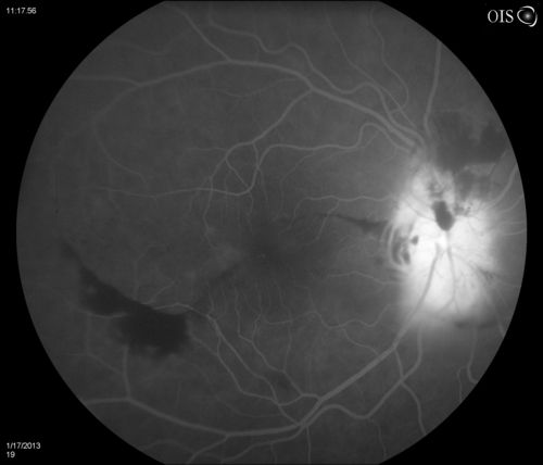 Diabetic Papillitis
Patient is about to undergo surgery for CNS Aneurysm. Patient woke up with little spots which never cleared up. Patients VA was 20/30-OD and 20/40-OS.  Both eyes appeared to have disc edema with hemorrhages in the right eye. Ordered a CT of the brain to make sure the aneurysm didn't ruptured.

