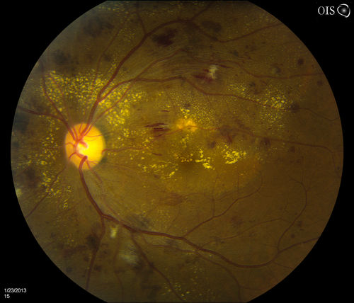 Combined Artery and Vein Occlusion
Patient comes in with decreased vision in both eyes. VA 20/200-OD, 20/60-OS. Fundus exam shows great amount of macular edema due to artery and vein occlusions. There is some neovascularization on the optic nerve in the right eye. Patient was treated with Eylea Injection in the left eye today and will return for Eylea Injection in the right eye.

