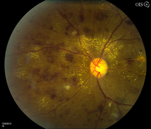 Combined Artery and Vein Occlusion
Patient comes in with decreased vision in both eyes. VA 20/200-OD, 20/60-OS. Fundus exam shows great amount of macular edema due to artery and vein occlusions. There is some neovascularization on the optic nerve in the right eye. Patient was treated with Eylea Injection in the left eye today and will return for Eylea Injection in the right eye.
