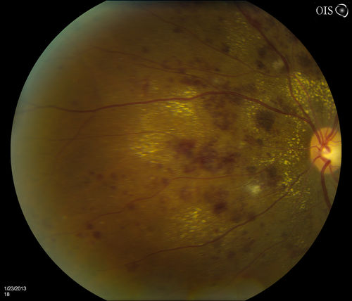 Combined Artery and Vein Occlusion
Patient comes in with decreased vision in both eyes. VA 20/200-OD, 20/60-OS. Fundus exam shows great amount of macular edema due to artery and vein occlusions. There is some neovascularization on the optic nerve in the right eye. Patient was treated with Eylea Injection in the left eye today and will return for Eylea Injection in the right eye.
