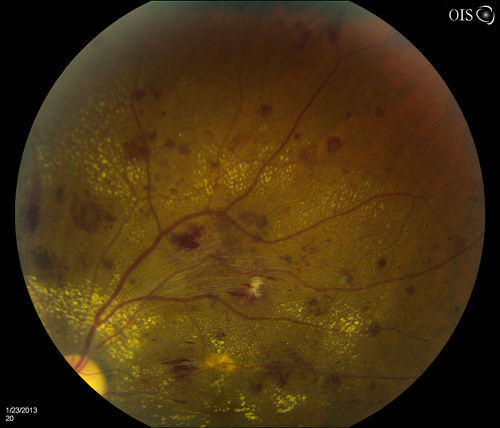 Combined Artery and Vein Occlusion
Patient comes in with decreased vision in both eyes. VA 20/200-OD, 20/60-OS. Fundus exam shows great amount of macular edema due to artery and vein occlusions. There is some neovascularization on the optic nerve in the right eye. Patient was treated with Eylea Injection in the left eye today and will return for Eylea Injection in the right eye.
