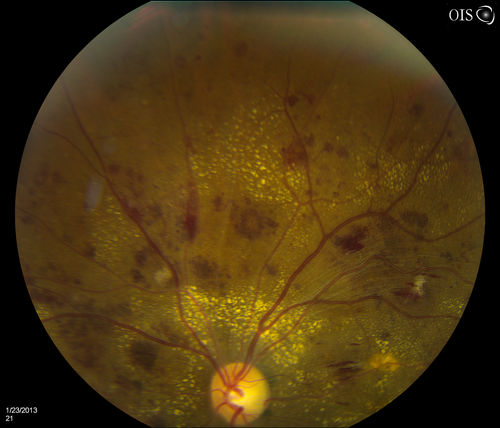 Combined Artery and Vein Occlusion
Patient comes in with decreased vision in both eyes. VA 20/200-OD, 20/60-OS. Fundus exam shows great amount of macular edema due to artery and vein occlusions. There is some neovascularization on the optic nerve in the right eye. Patient was treated with Eylea Injection in the left eye today and will return for Eylea Injection in the right eye.

