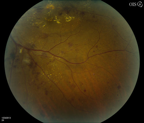Combined Artery and Vein Occlusion
Patient comes in with decreased vision in both eyes. VA 20/200-OD, 20/60-OS. Fundus exam shows great amount of macular edema due to artery and vein occlusions. There is some neovascularization on the optic nerve in the right eye. Patient was treated with Eylea Injection in the left eye today and will return for Eylea Injection in the right eye.
