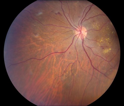 Nonproliferative Diabetic Retinopathy
65-year old female with diabetes. Has had cataract surgery in the left eye with VA 20/25. She has had laser in the past. Fundus examination shows microaneurysms with retinal hemorrahages and exudates in the left eye. 
